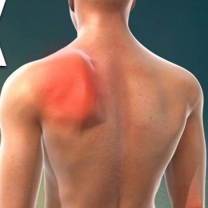 How To Fix Scapula Winging Problem