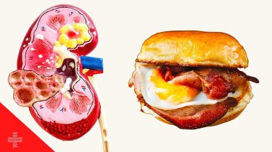 10 Foods To Avoid For Kidney Health