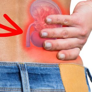 All You Need to Know About Kidney Stones
